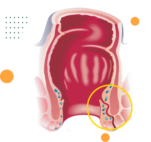 Fistula Anorretal