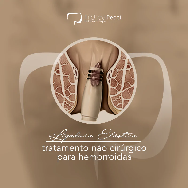 ligadura dra andrea pecci proctologista em são paulo