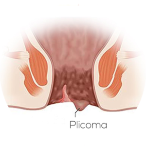 plicoma anal são paulo dra andrea pecci proctologista