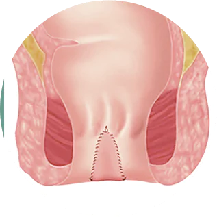 eletrocautertização de verrugas anais dra andrea pecci proctologista em são paulo