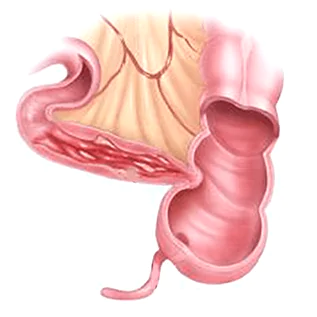 doenças inflamatorias intestinais dra andrea pecci proctologista em são paulo