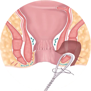 exerese de leões perianais dra andrea pecci proctologista em são paulo