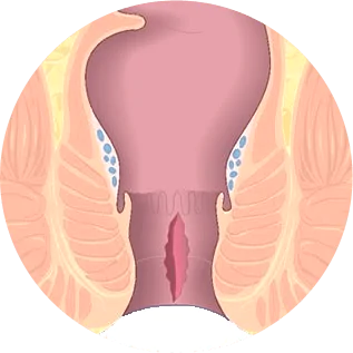 fissura anal dra andrea pecci proctologista em são paulo