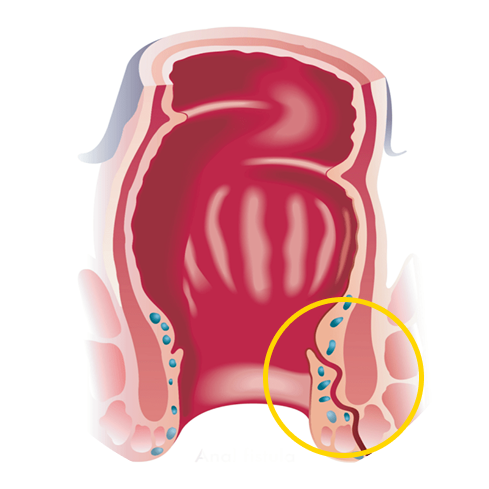 cirurgia de fistula anorretal dra andrea pecci proctologista em são paulo