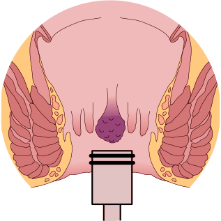 ligadura elastica dra andrea pecci proctologista em são paulo