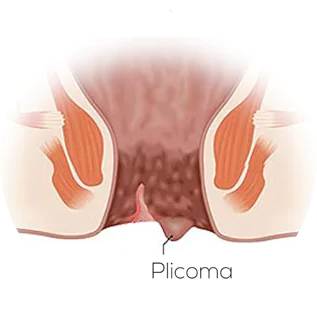 cirurgia de plicoma anal dra andrea pecci proctologista em são paulo