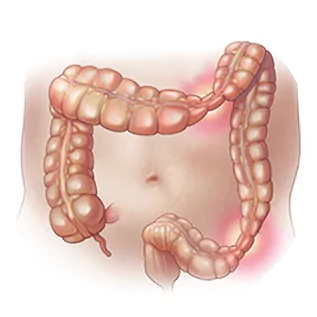 sindrome do intestino irritavel dra andrea pecci proctologista em são paulo