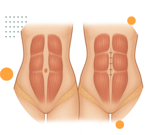diastase do reto abdominal