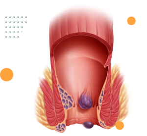 hemorroida detalhe tratamento para hemorroida dra andrea pecci proctologista em são paulo