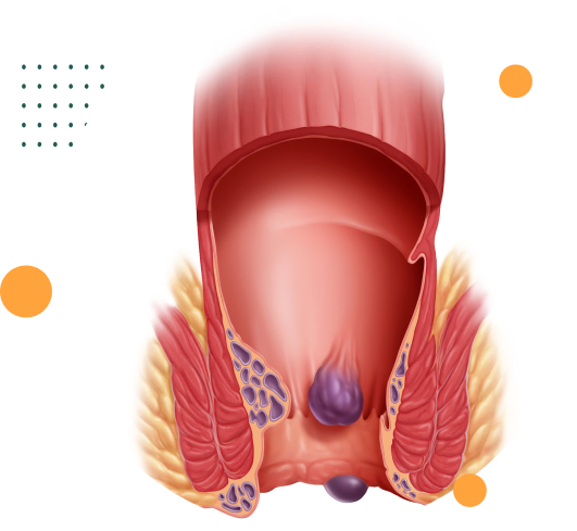 hemorroida detalhe tratamento para hemorroida dra andrea pecci proctologista em são paulo