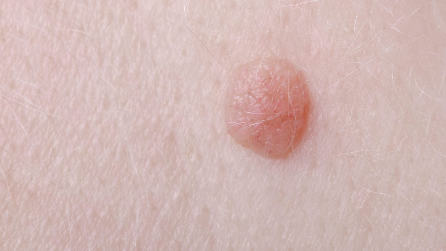 verrugas anais dra andrea pecci proctologista