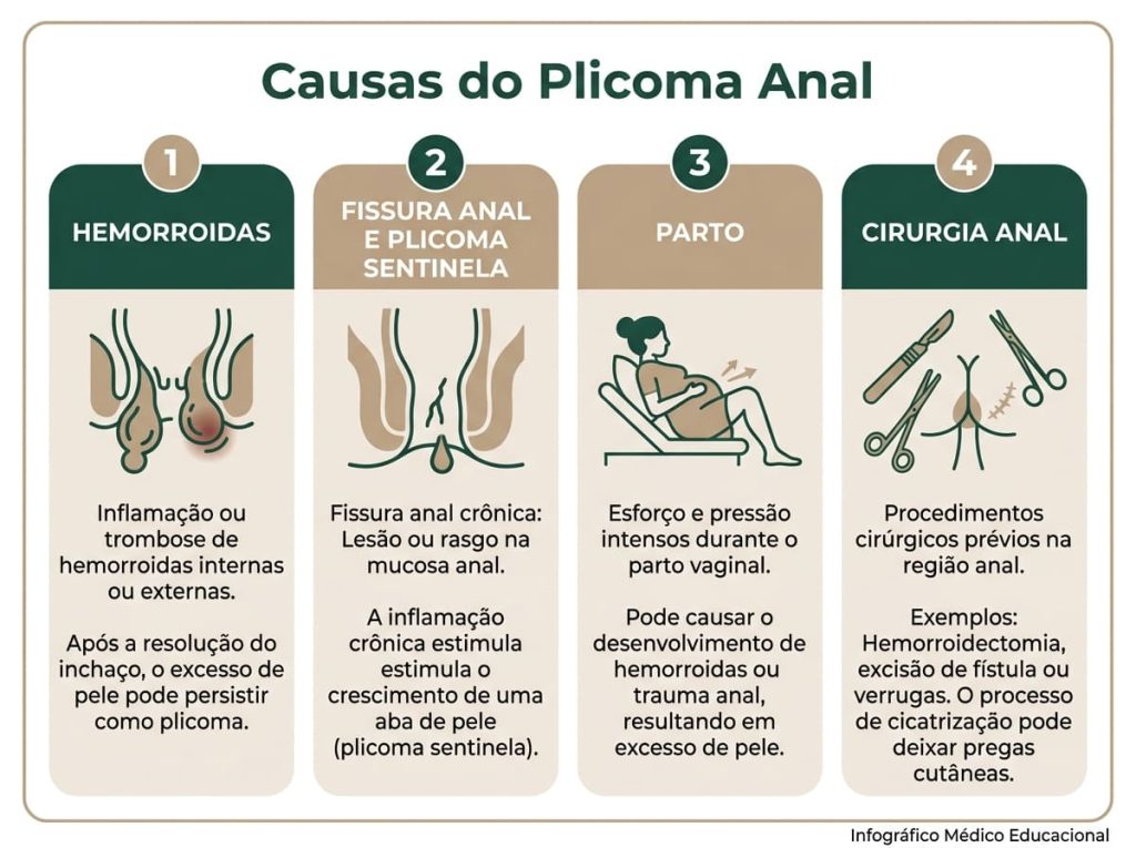 Plicoma Anal 2 Infográfico com as principais causas do plicoma anal: hemorróida, fissura anal, gravidez, cirurgia perianal